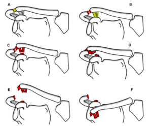 Luxação da Articulação Acromioclavicular l Dr. Ricardo Palombini