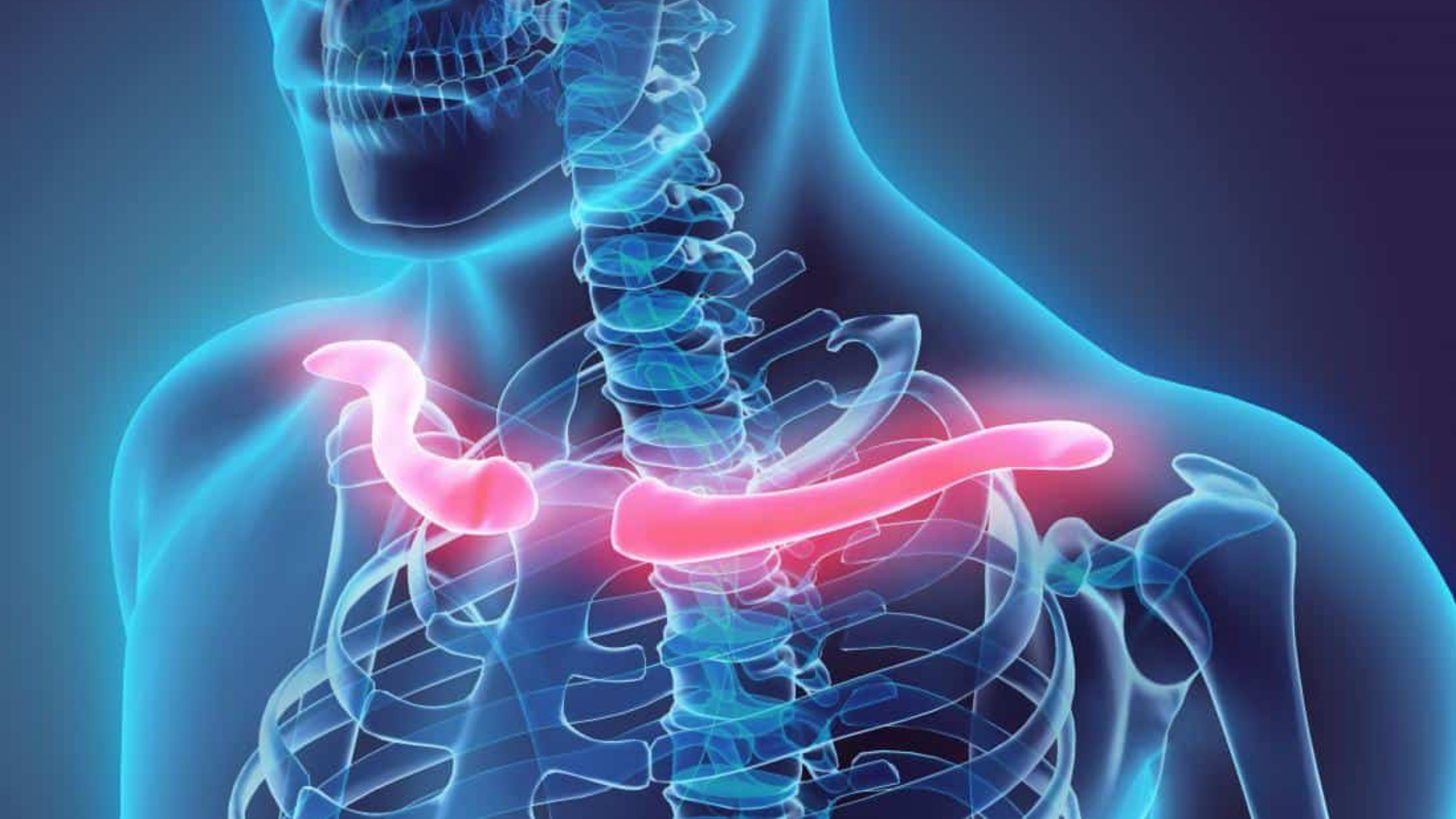 Luxação da Articulação Acromioclavicular